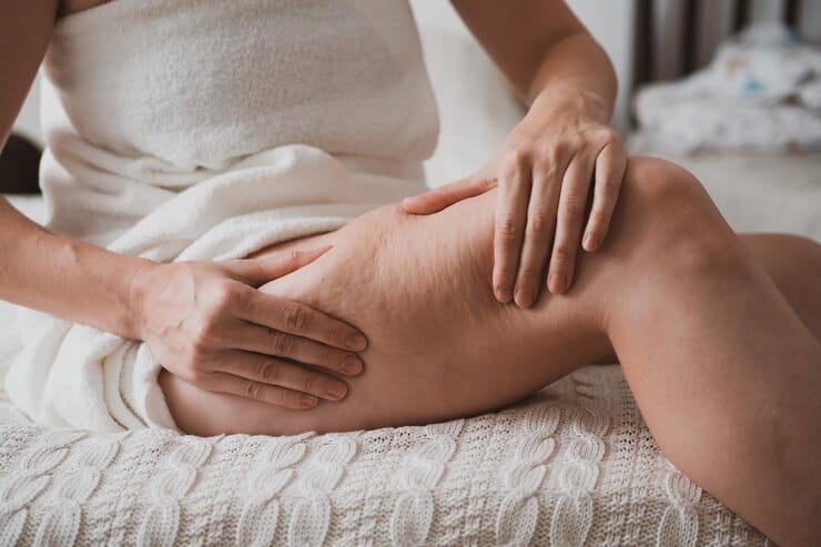 Cellulite-Free Skin with Emtone