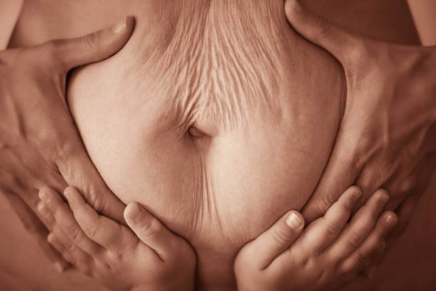cellulite removal by emtone