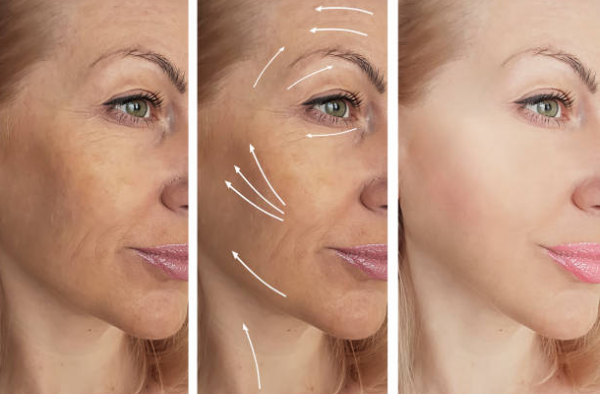 skin tightening